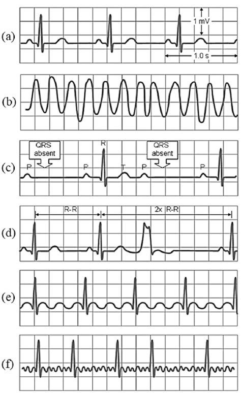 ekg readings abnormal|what does a normal ekg look like.